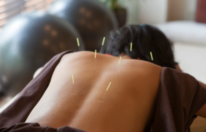 Acupuncture